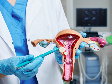 what are uterine fibroids